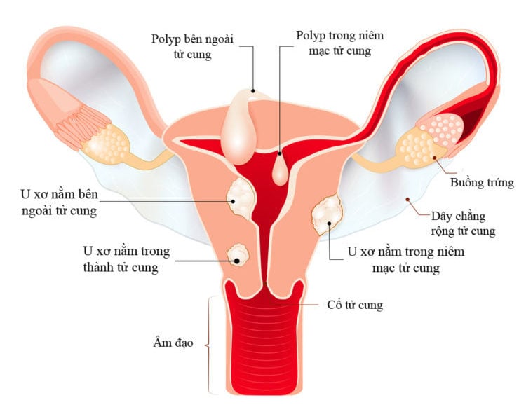  Ảnh hưởng của U Xơ Tử Cung đối với Mang Thai và Khả Năng Sinh Sản