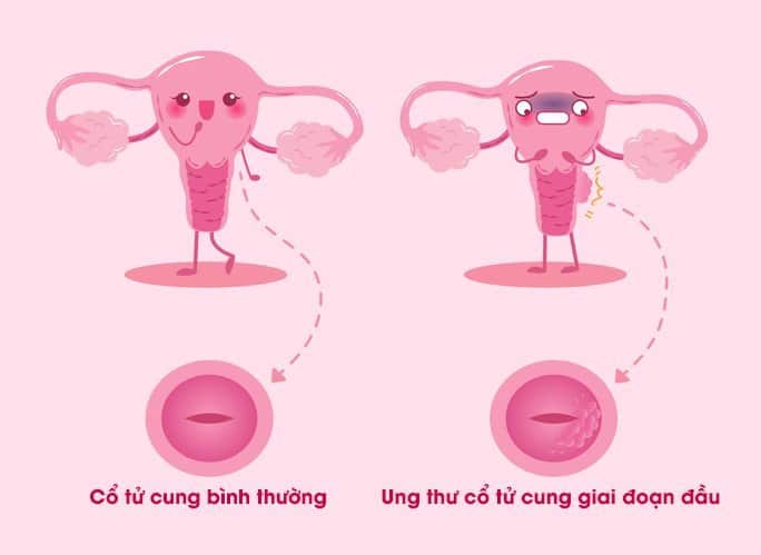  Ung thư Cổ Tử Cung Giai Đoạn Đầu: Triệu Chứng, Chẩn Đoán và Điều Trị