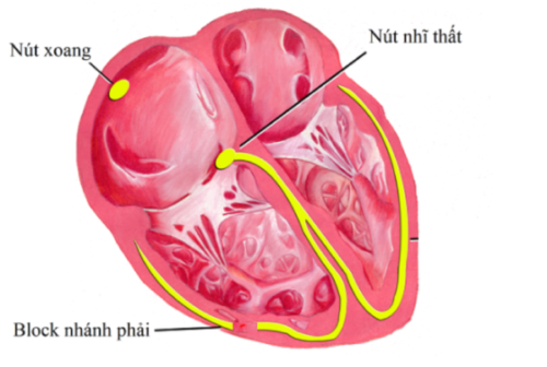  Block nhánh phải: Nguyên nhân, triệu chứng và phương pháp điều trị