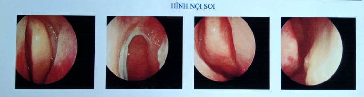  Concha Bullosa: Nguyên nhân, Triệu chứng và Điều trị