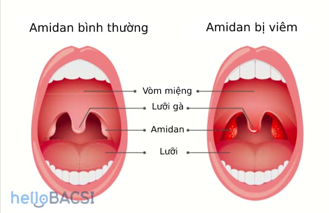  Viêm Amidan: Lây lan, Triệu chứng và Phương pháp Điều trị