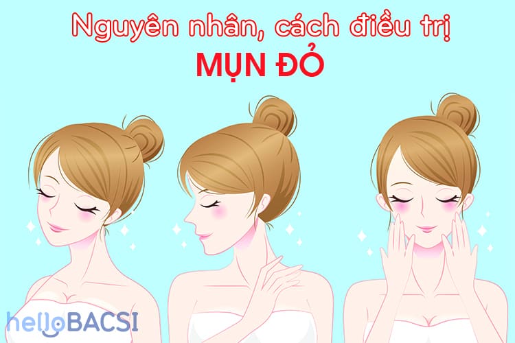  Giải quyết mụn đỏ sưng tấy: Nguyên nhân, triệu chứng và phương pháp điều trị hiệu quả