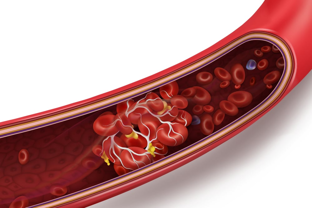  Apixaban: Thuốc Làm Loãng Máu, Ngăn Ngừa Cục Máu Đông