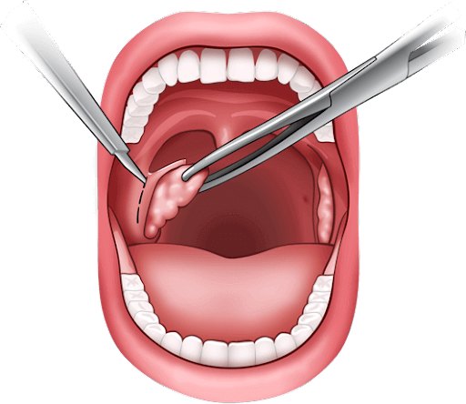  Cắt amidan: Lợi ích, Rủi ro và Chăm sóc sau phẫu thuật