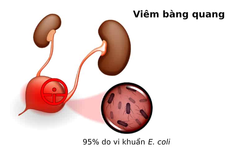  Viêm bàng quang: Nguyên nhân, triệu chứng, chẩn đoán và điều trị