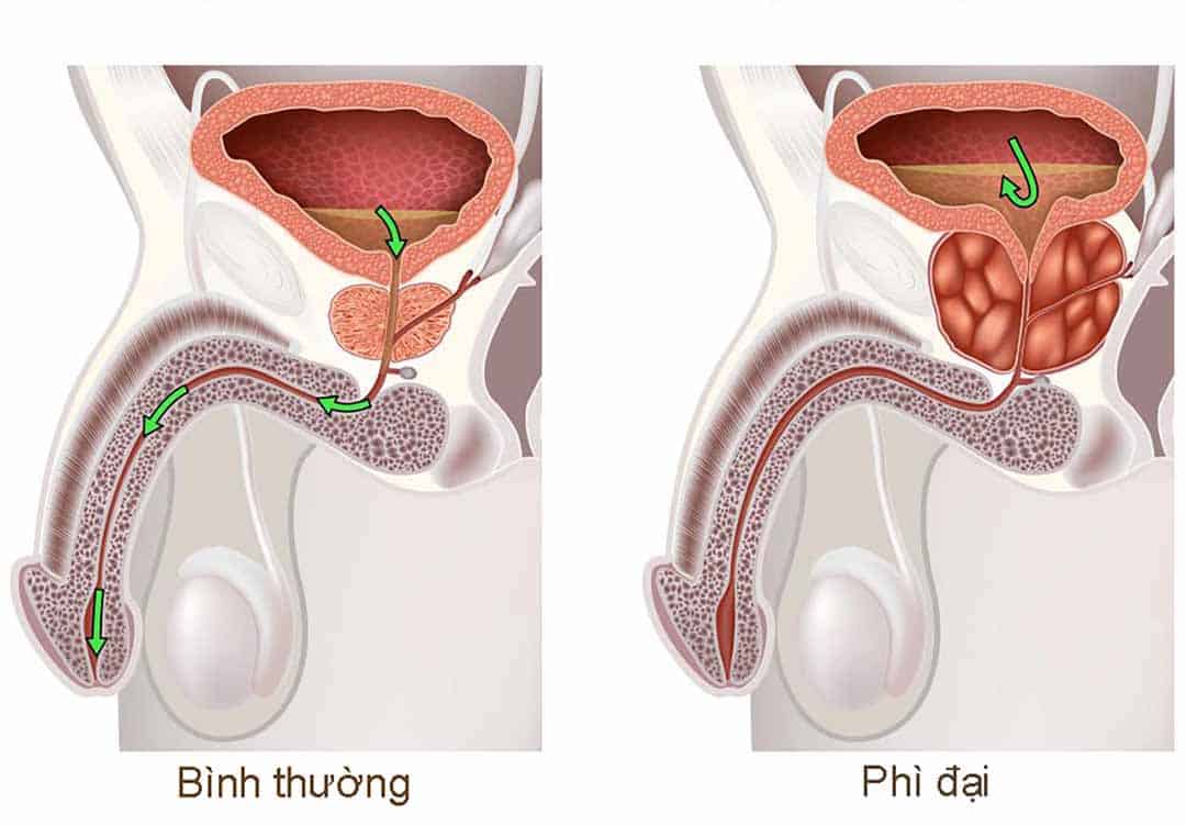  Phì đại tuyến tiền liệt: Hướng dẫn toàn diện về các phương pháp điều trị