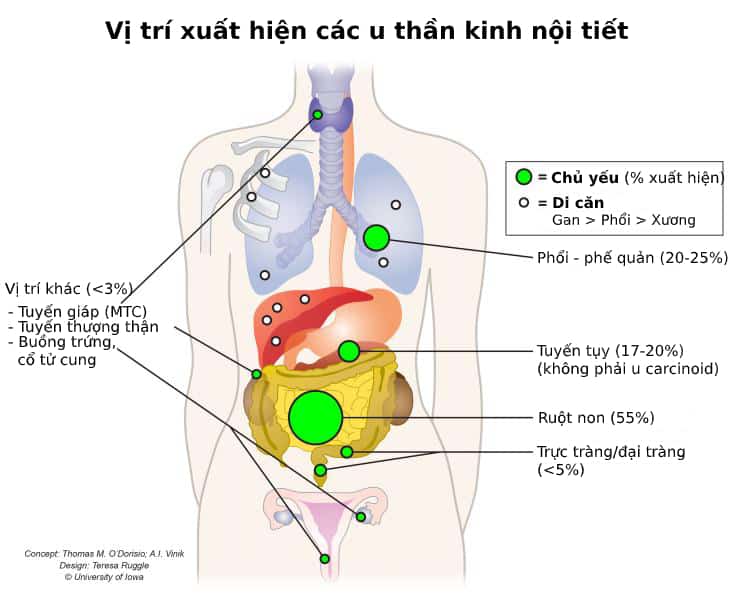  U thần kinh nội tiết: Tổng quan toàn diện về nguyên nhân, triệu chứng và điều trị