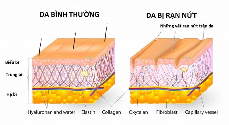  Hiểu rõ về rạn da màu đỏ ở bắp chân: Nguyên nhân và cách điều trị hiệu quả