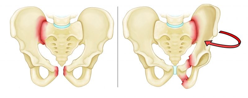  Gãy xương vùng chậu: Nguyên nhân, Triệu chứng, Chẩn đoán và Điều trị