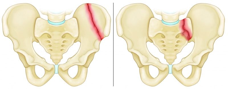  Gãy xương vùng chậu: Nguyên nhân, Triệu chứng, Chẩn đoán và Điều trị