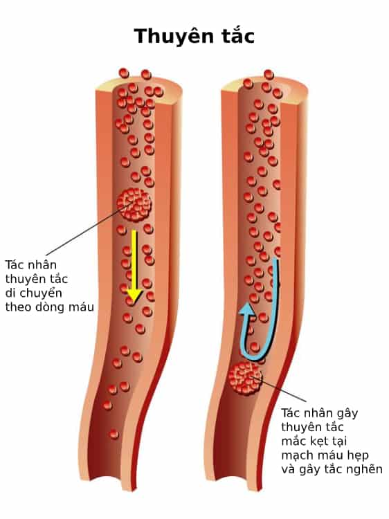  Thuyên tắc mạch máu: Nguyên nhân, Triệu chứng, Chẩn đoán và Phòng ngừa