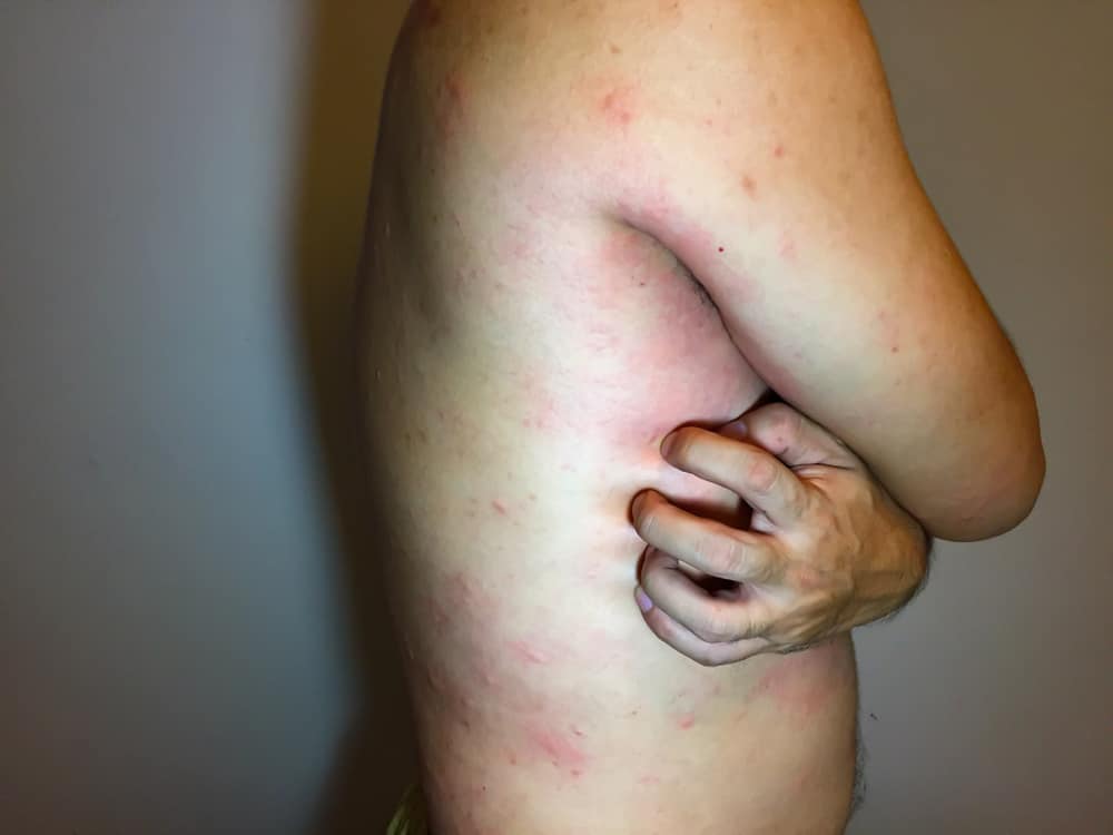  Bệnh Lupus: Tổng quan, Triệu chứng, Nguyên nhân, Chẩn đoán và Điều trị