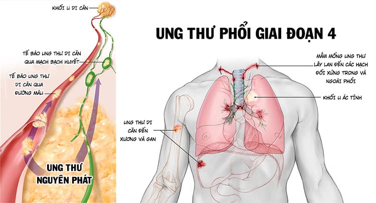  Ung thư phổi di căn xương: Triệu chứng, Tỷ lệ sống sót và Điều trị