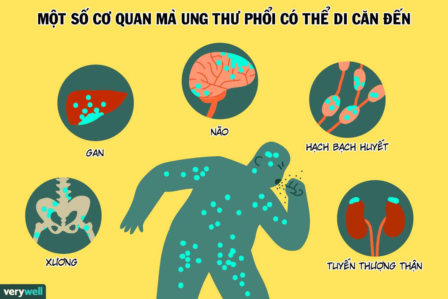  Ung thư phổi di căn xương: Triệu chứng, Tỷ lệ sống sót và Điều trị