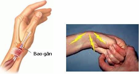  Viêm bao gân: Tổng quan toàn diện về nguyên nhân, triệu chứng và điều trị