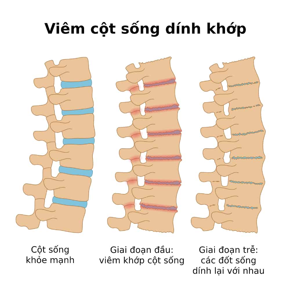  Viêm Cột Sống Dính Khớp: Nguyên Nhân, Triệu Chứng và Điều Trị