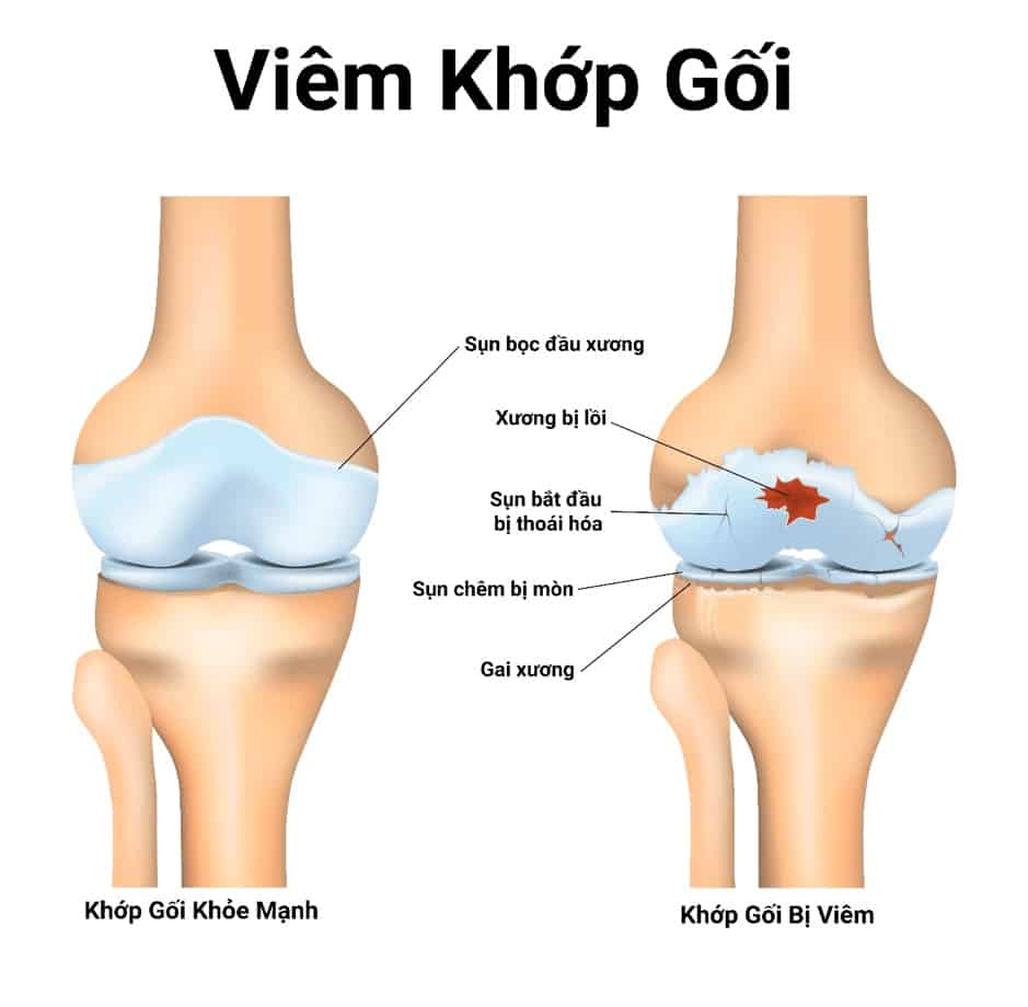  Thoái hóa khớp gối: 9 biện pháp hiệu quả tại nhà