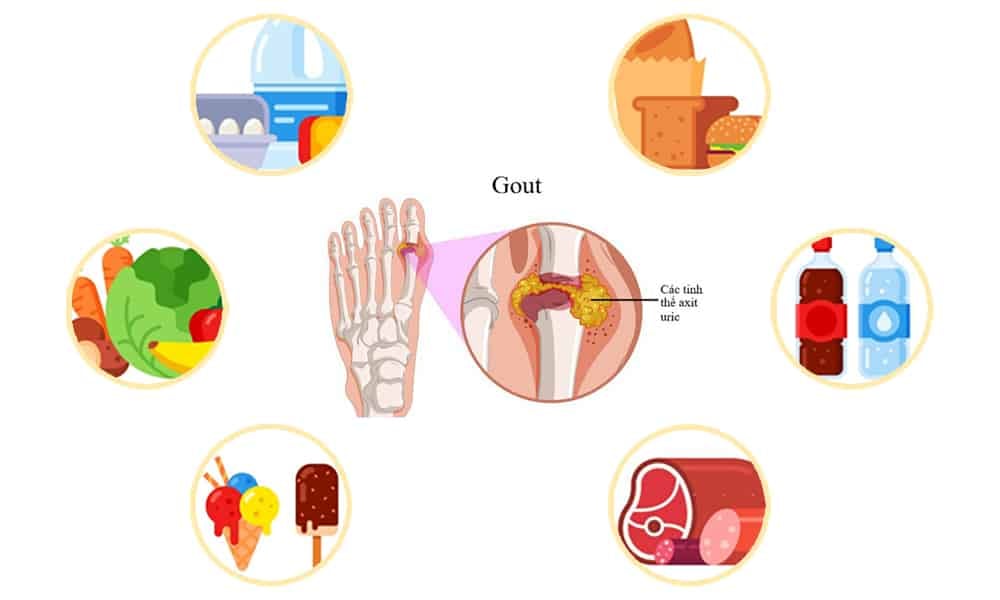  Bệnh Gout: Nguyên nhân, Biểu hiện và Chế độ Ăn kiêng Hiệu quả