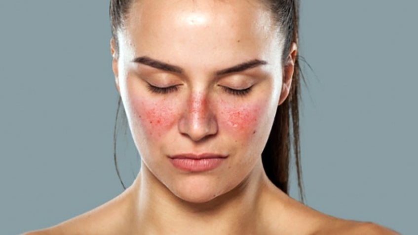  Lupus Ban Đỏ: Một Bệnh Tự Miễn Phổ Biến