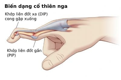  Biến dạng cổ thiên nga: Nguyên nhân, triệu chứng và phương pháp điều trị