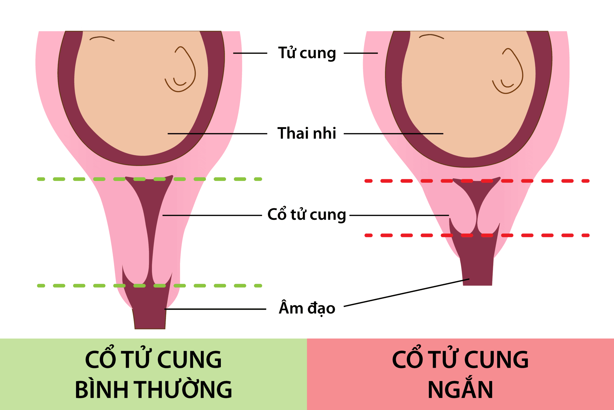  Cổ tử cung ngắn khi mang thai: Nguyên nhân, nguy cơ và phương pháp điều trị