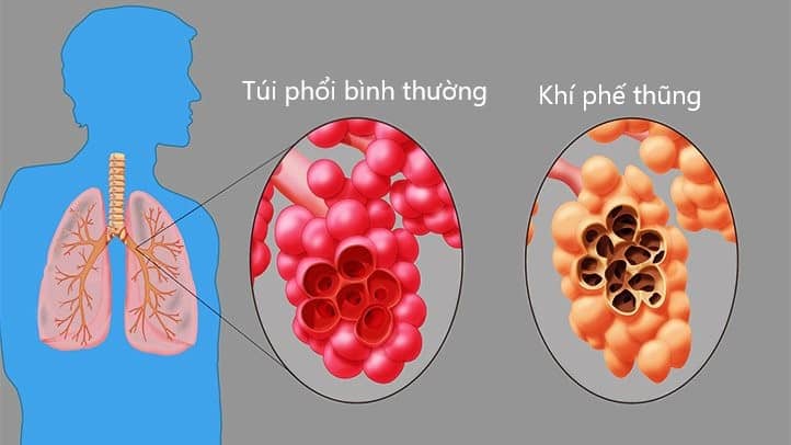  Khí phế thũng: Nguyên nhân, Triệu chứng và Điều trị