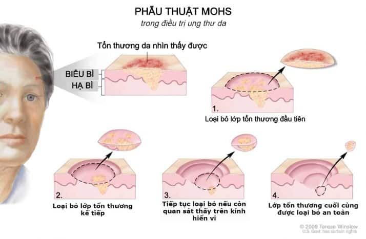  Hướng dẫn Toàn diện về Điều trị Ung thư Da: Các Phương pháp Hiệu quả và Tỷ lệ Thành công