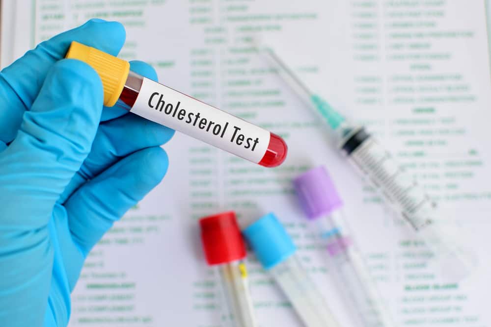  Xét nghiệm Cholesterol Toàn Phần: Hướng Dẫn Chi Tiết