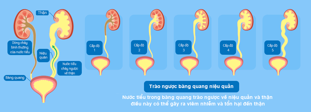  Giãn đài bể thận ở thai nhi: Nguyên nhân, nguy cơ và phương pháp điều trị