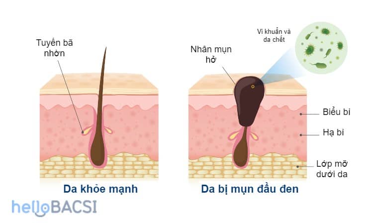  Những Hiểu Lầm Về Mụn Trứng Cá: Vén Bức Màn Sự Thật