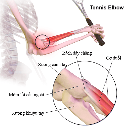  Hướng Dẫn Toàn Diện Về Đau Khuỷu Tay: Nguyên Nhân, Triệu Chứng Và Điều Trị