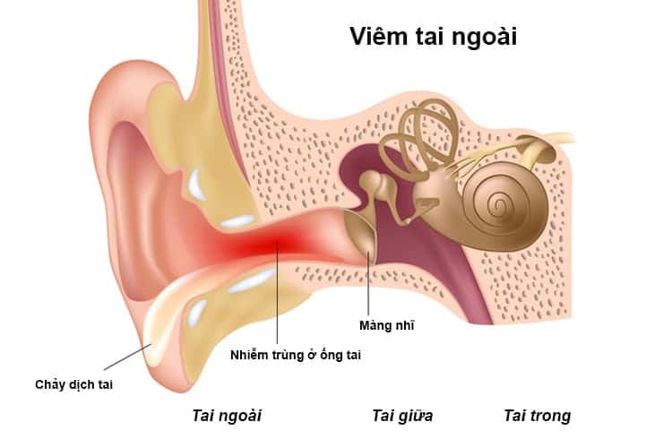  Cách tự điều trị viêm tai ngoài tại nhà: 7 phương pháp hiệu quả