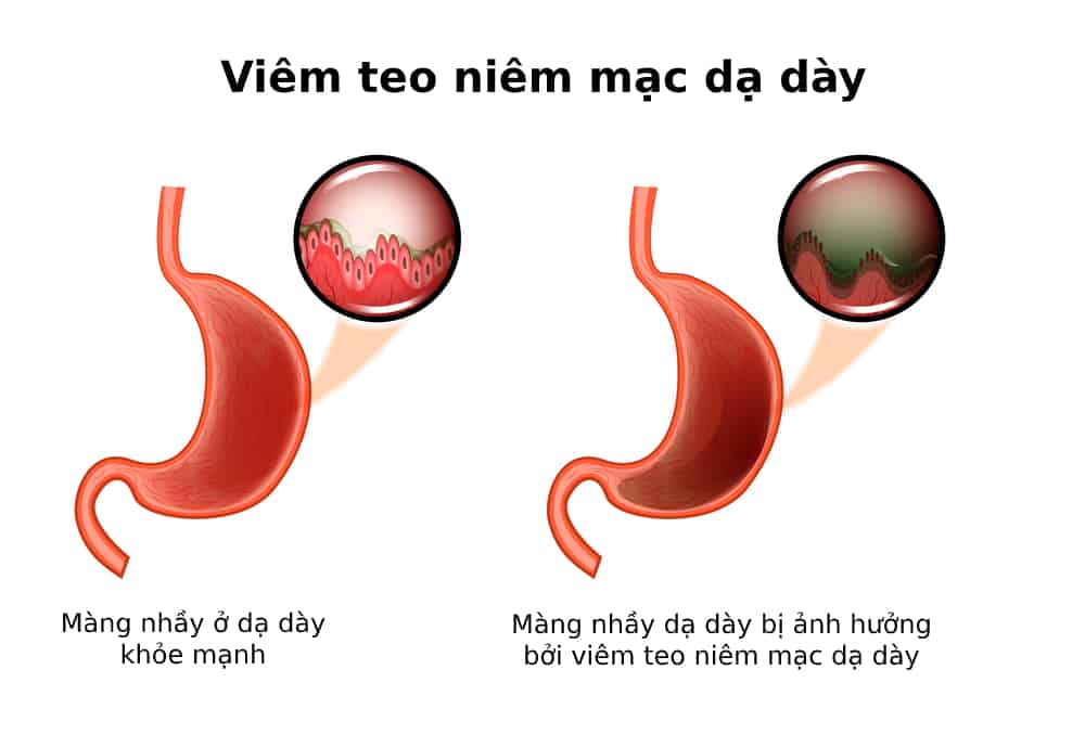  Viêm Teo Niêm Mạc Dạ Dày: Nguyên Nhân, Triệu Chứng, Điều Trị và Phòng Ngừa