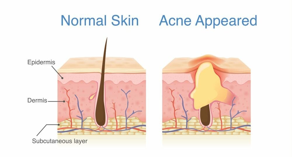  Acnotin: Thuốc Trị Mụn Trứng Cá Nặng Hiệu Quả và Những Lưu Ý Quan Trọng