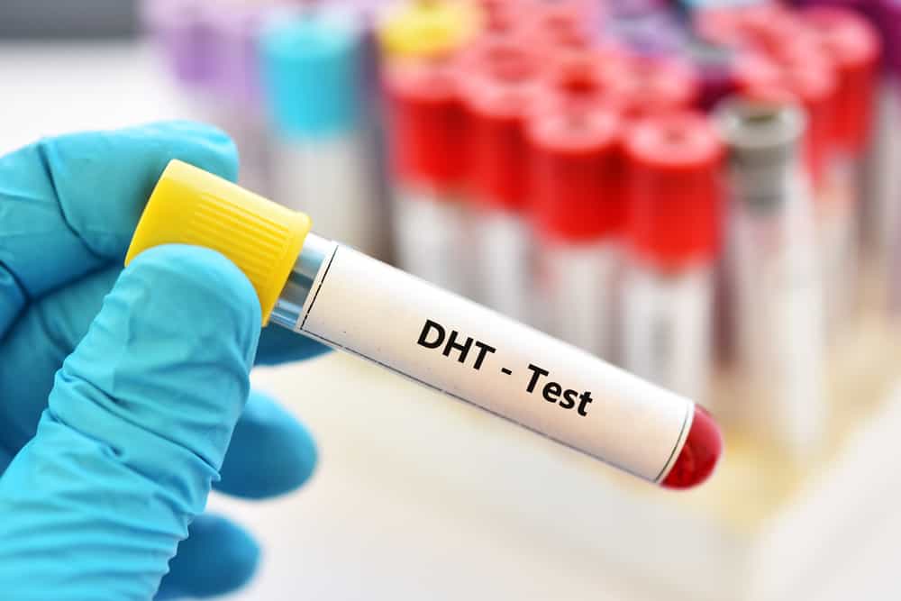  Hormone DHT: Vai trò trong Rụng tóc kiểu Hói đầu ở Nam giới