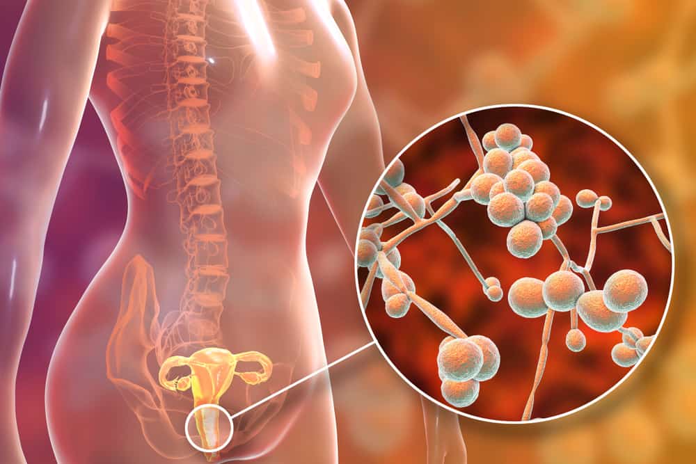  Nhiễm nấm Candida: Tổng quan toàn diện về Nguyên nhân, Triệu chứng và Điều trị