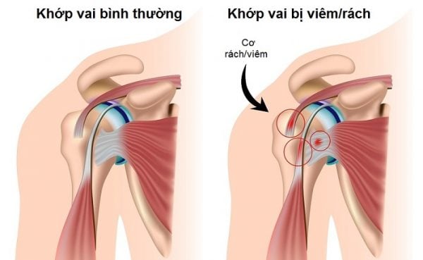  Rách Chóp Xoay Khớp Vai: Nguyên Nhân, Triệu Chứng và Điều Trị