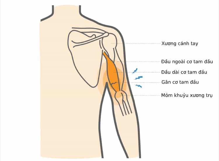  Rách cơ tam đầu cánh tay: Nguyên nhân, Triệu chứng và Điều trị