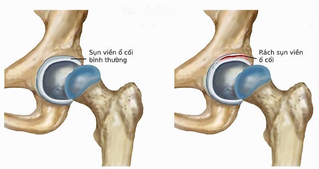  Rách Sụn Viền Ổ Cối: Nguyên Nhân, Triệu Chứng và Điều Trị