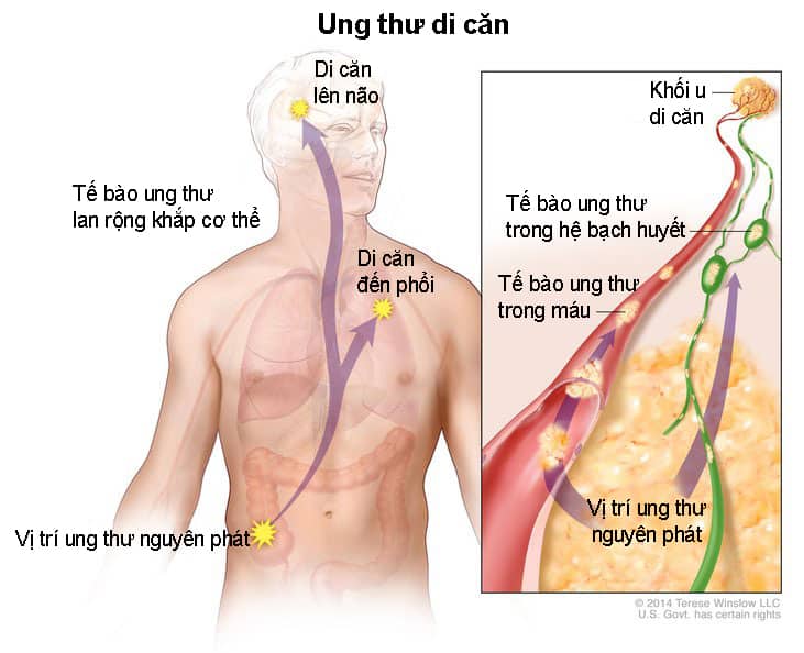  Ung thư di căn đến phổi: Triệu chứng, chẩn đoán, điều trị và phòng ngừa