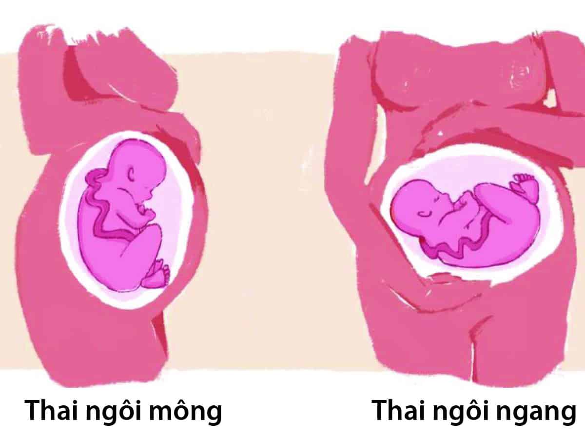  Thai Ngôi Ngang: Nguyên Nhân, Nguy Cơ và Cách Khắc Phục