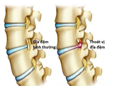  Thoái hóa Khớp và Thoát Vị Đĩa Đệm: Triệu Chứng, Nguyên Nhân và Phương Pháp Điều Trị