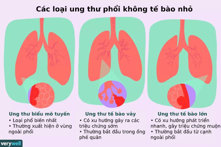  Bệnh Ung Thư Phổi Không Tế Bào Nhỏ: Triệu Chứng, Nguyên Nhân, Chẩn Đoán và Điều Trị