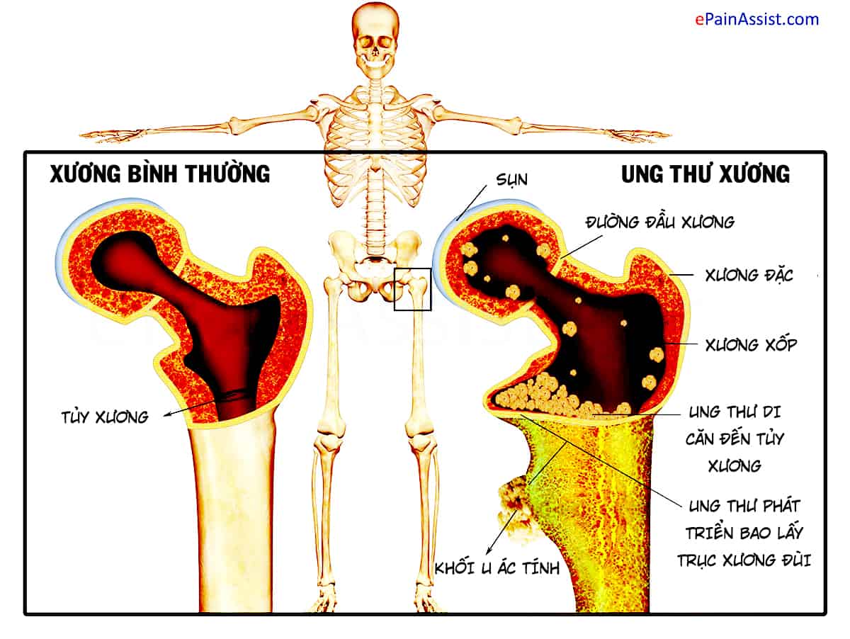  Hiểu về Ung thư Xương Giai đoạn Cuối: Triển vọng, Phân loại và Thống kê