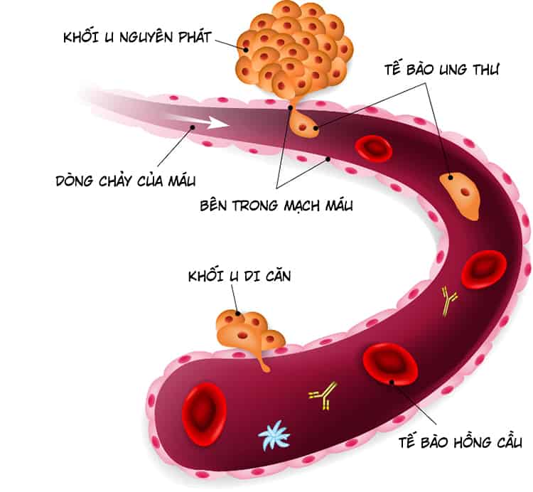  Hiểu về Ung thư Xương Giai đoạn Cuối: Triển vọng, Phân loại và Thống kê