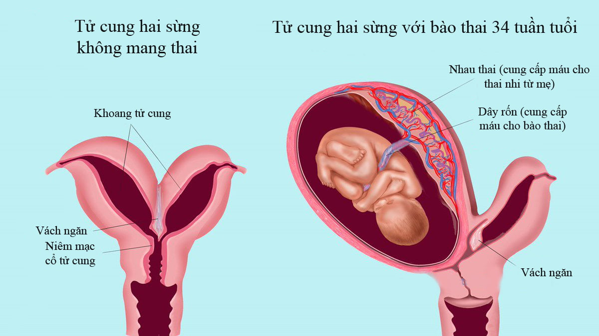  Tử cung hai sừng: Hiểu rõ nguyên nhân, triệu chứng và phương pháp điều trị