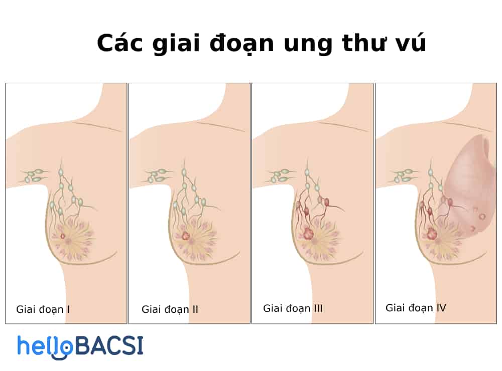  Ung thư vú: Di truyền và các yếu tố nguy cơ