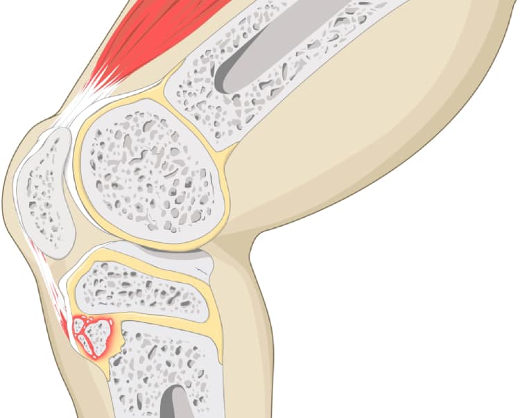  Đau khớp gối: Nguyên nhân, Biểu hiện và Phương pháp điều trị