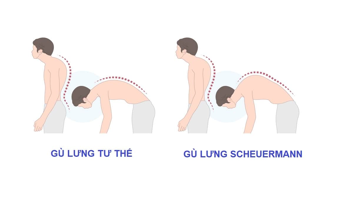  Gù lưng trẻ em: Nguyên nhân, triệu chứng và phương pháp điều trị