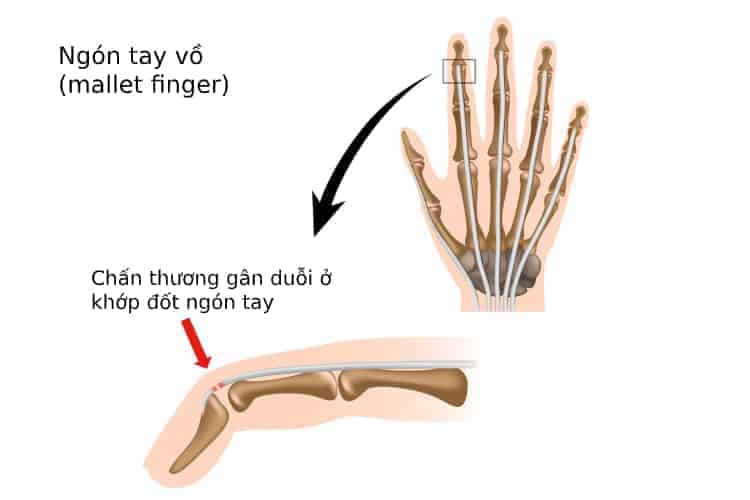  Ngón Tay Vồ: Nguyên Nhân, Triệu Chứng và Phương Pháp Điều Trị Hiệu Quả